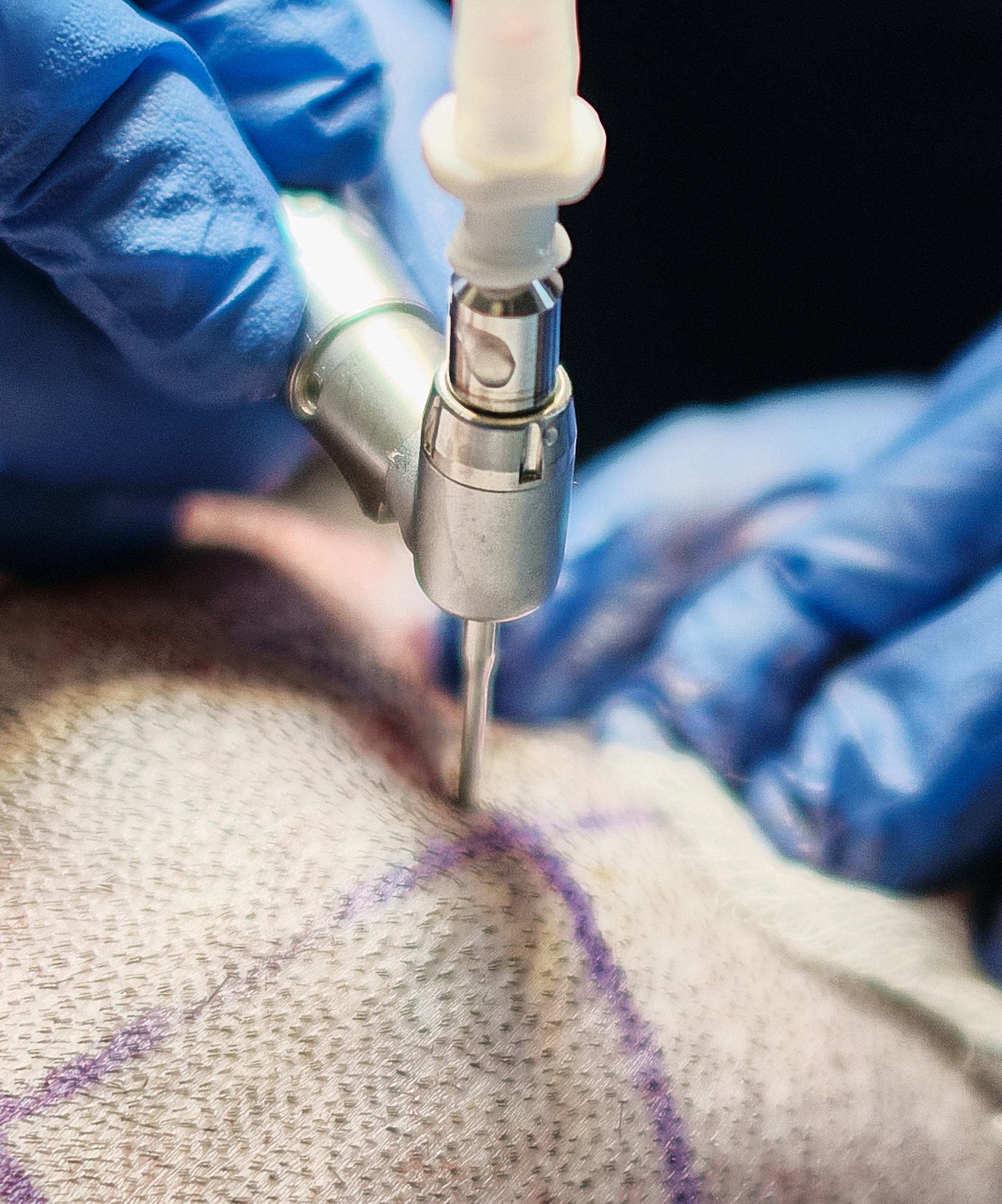 Hair Transplant Toronto Clinic - FUE Hair Transplant Toronto Clinic - FUE