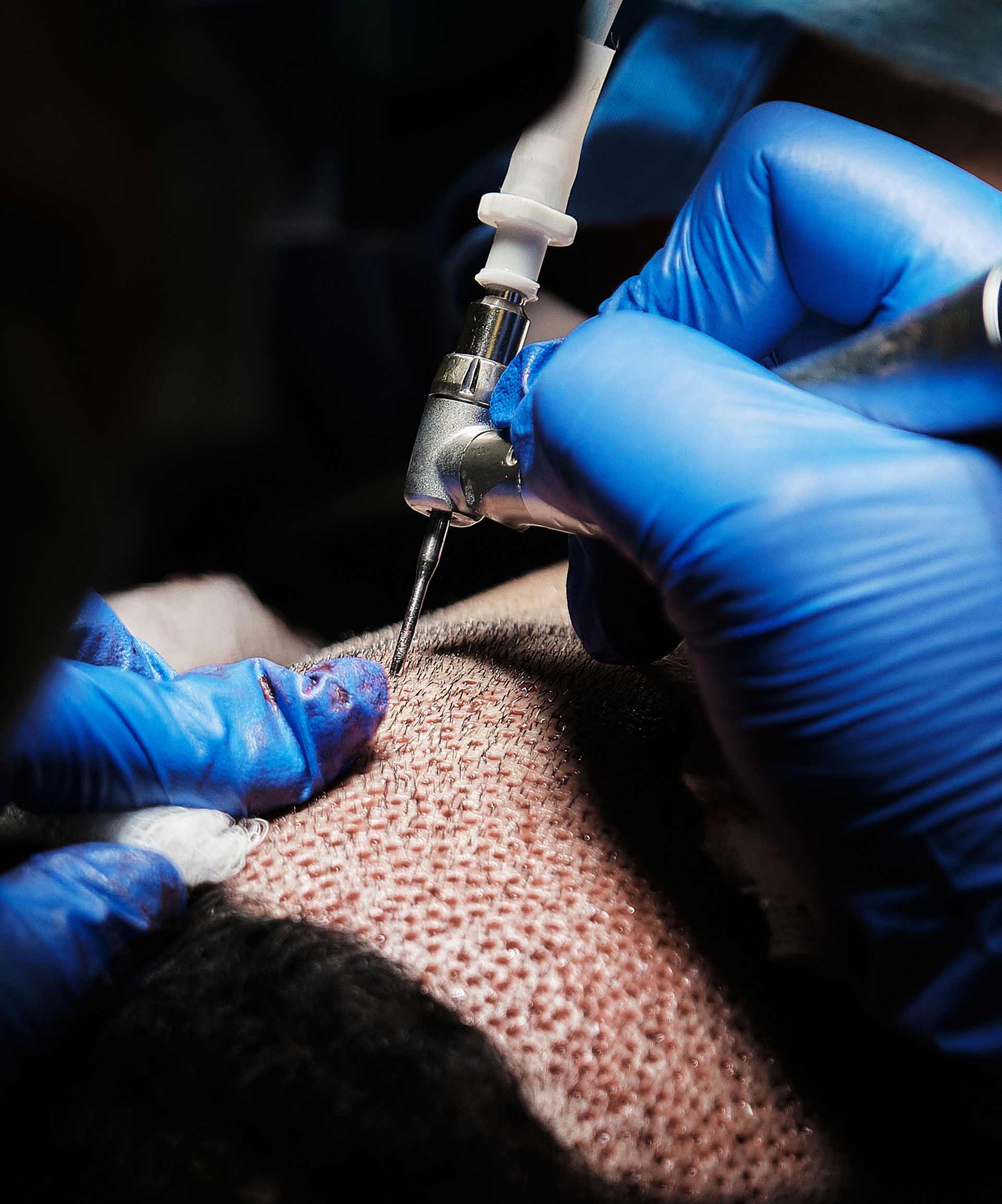 Hair Transplant Toronto Clinic - FUE Extract Hair Transplant Toronto Clinic - FUE Extract